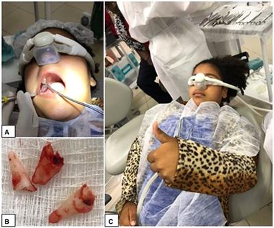 APPLICABILITY OF SEDATION WITH NITROUS OXIDE IN THE MANAGEMENT OF MOLAR INCISOR HYPOMINERALIZATION IN PEDIATRIC PATIENTS: CLINICAL CASE SERIES
